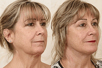 Head & Neck Reconstruction Surgery in Mumbai